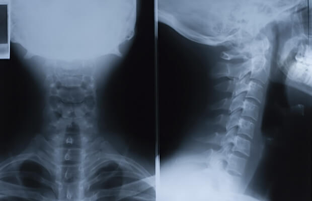 Какви са симптомите и лечението на тумори на гръбначния стълб?